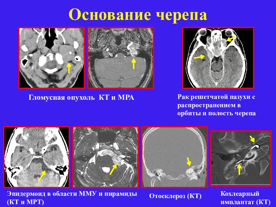 Что означает кт. Гломусная опухоль яремного отверстия. Основание черепа мрт анатомия. Гломусная опухоль височной кости кт.