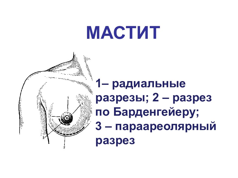 Мастит хирургия презентация