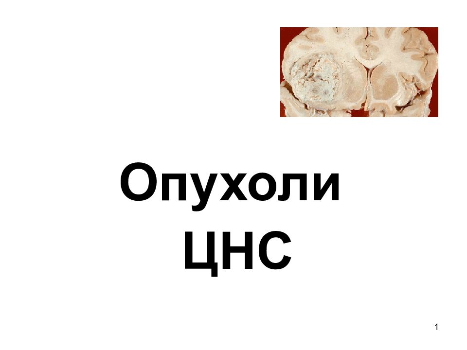Опухоли ЦНС