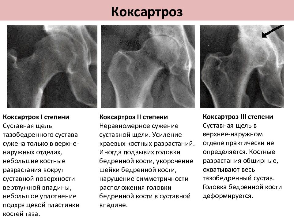 Коксартроз презентация травматология