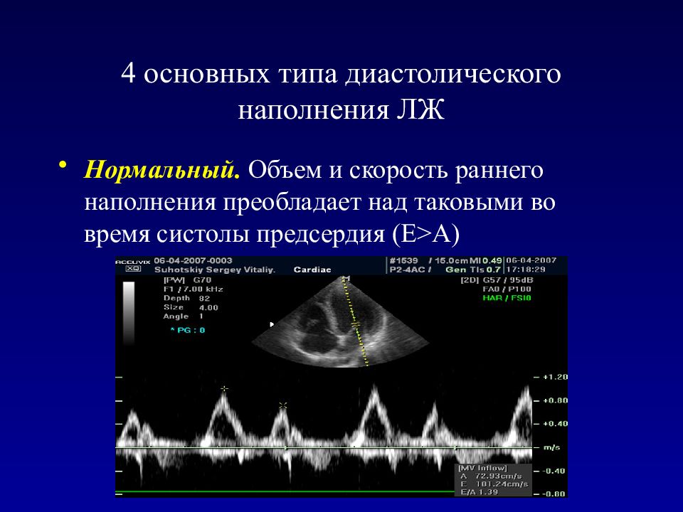 Диастолическая левого желудочка. Диастолическая функция ЭХОКГ. Диастолическая дисфункция ЭХОКГ. Оценка диастолической функции. ЭХОКГ показатели диастолической функции.