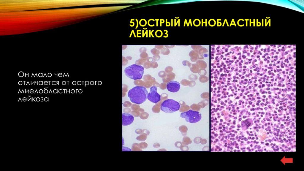 Миелолейкоз и лимфолейкоз. Острый эритромиелобластный лейкоз. Острый монобластный лейкоз. Лейкоз презентация.