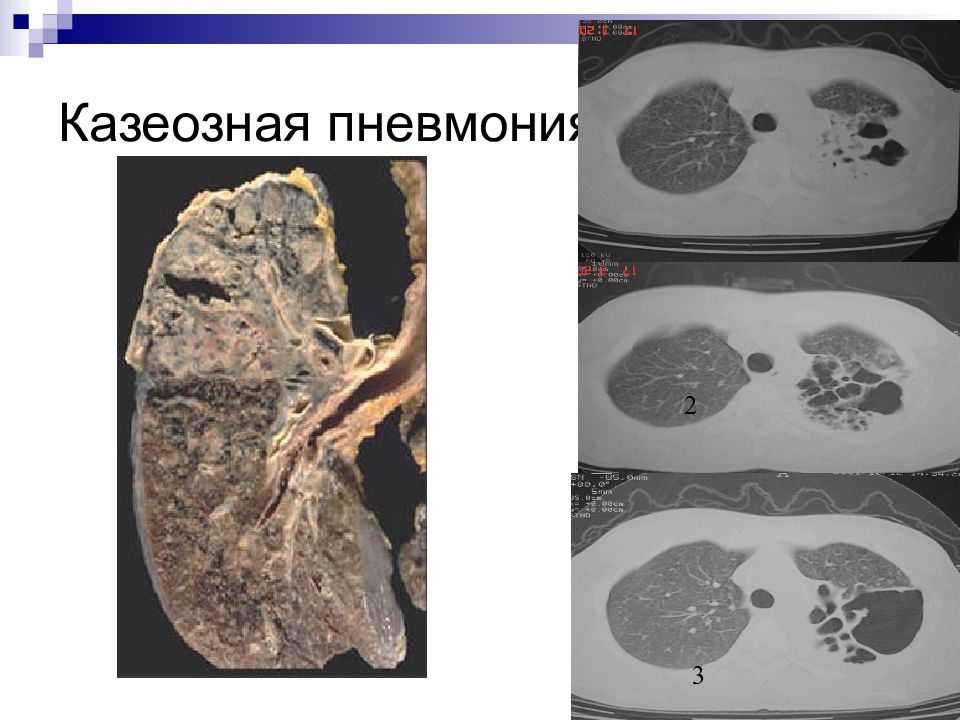 Казеозная пневмония фото