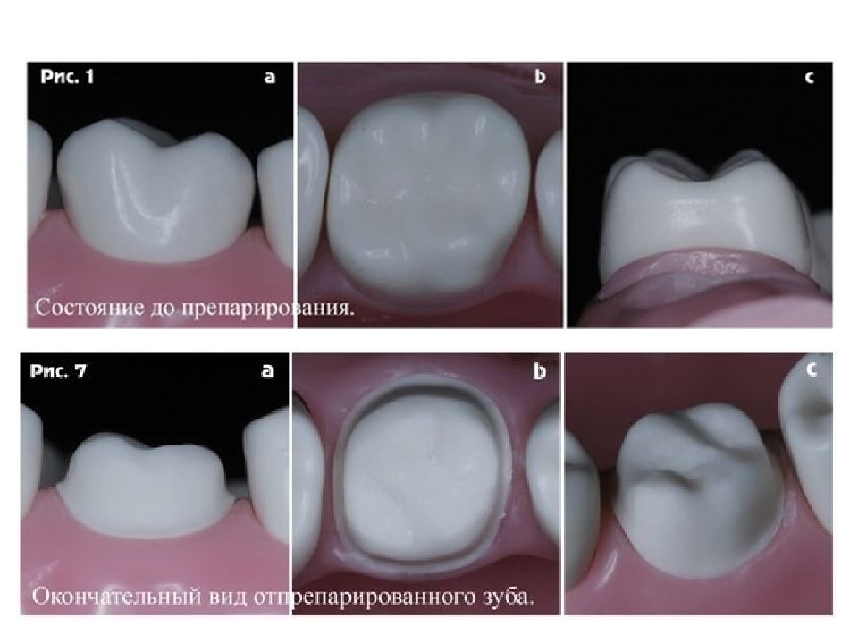 Дефект твердых тканей. Препарирование зуба под искусственную коронку. Препарирование под штампованную коронку. Толщина препарирования под zro2.