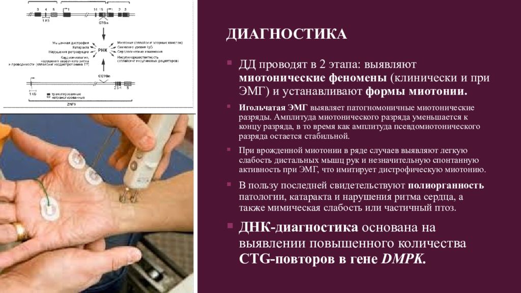 Миотоническая дистрофия. Миотония Куршмана Баттена Штейнерта. Миотония Россолимо Штейнерта Куршмана. Миотоническая дистрофия Куршмана-Баттена-Штейнерта. Миотония ЭНМГ.