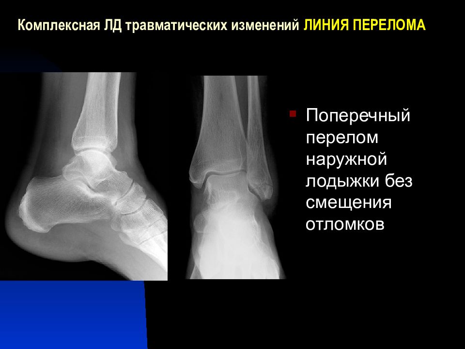 Перелом наружной лодыжки рисунок