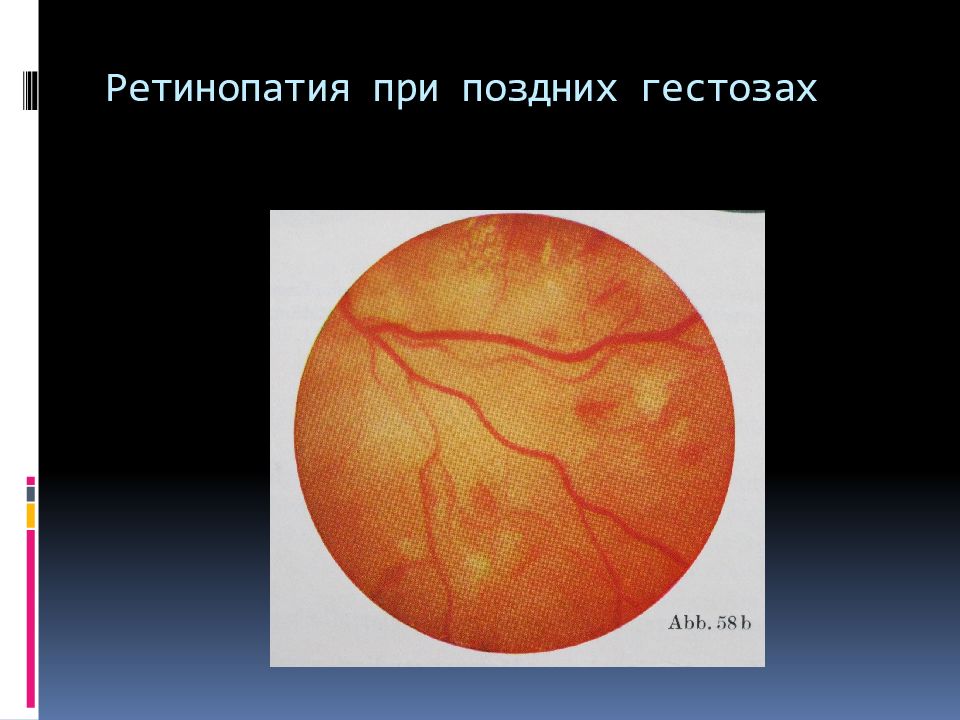 Заболевания сетчатки и зрительного нерва презентация