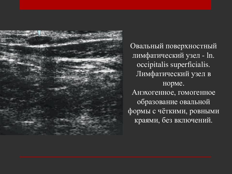 Узи лимфатических узлов. УЗИ лимфатических узлов норма. Паховые лимфатические узлы УЗИ норма. Строение лимфоузла на УЗИ норма. Нормальные лимфатические узлы на УЗИ.