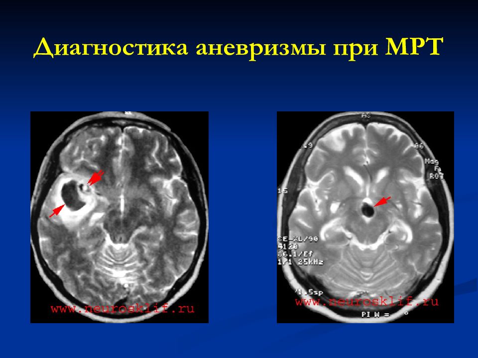 Форум аневризма мозга. Аневризма головного мозга мрт. Аневризма головного мозга на кт. Аневризма сосудов головного мозга на мрт. Аневризма головного мозга снимки.