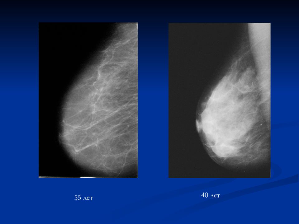 Лучевая рак молочной железы. Рентгенодиагностика заболеваний молочной железы. Дуктография молочной железы лучевая диагностика. Киста молочной железы рентгенодиагностика. Luchevaya_diagnostika_zabolevania_malochnykh_zhelez.
