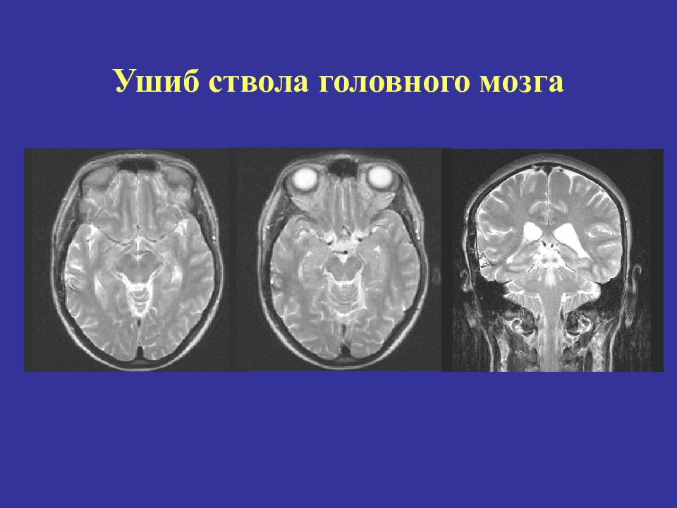 Травма ствола головного мозга. Ушиб ствола головного мозга. Ушиб ствола головного мозга последствия. Повреждение ствола головного.