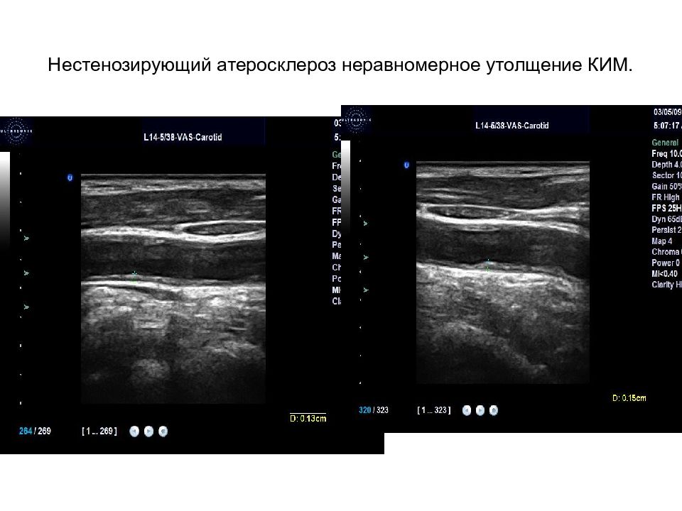 Нестенозирующий атеросклероз. Атеросклеротическая бляшка УЗИ. Атеросклероз сосудов нижних конечностей на УЗИ. Атеросклероз сосудов УЗИ.