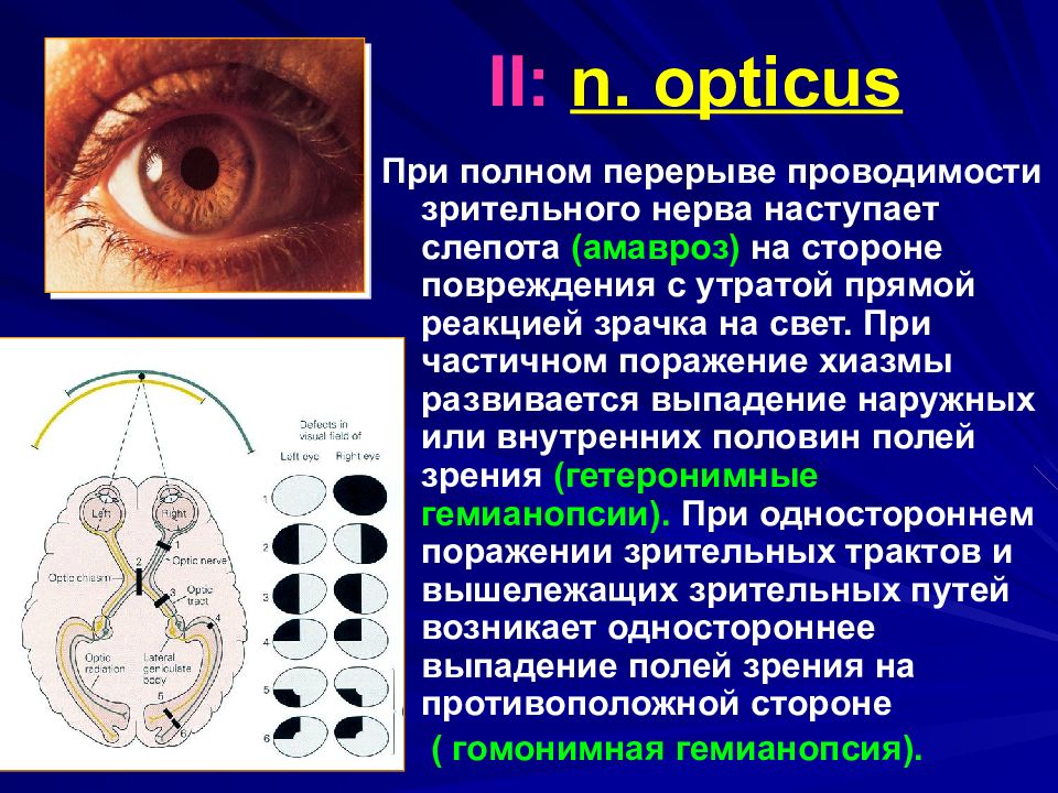 Оптикус. Симптомы поражения зрительного нерва. Поражение хиазмы.