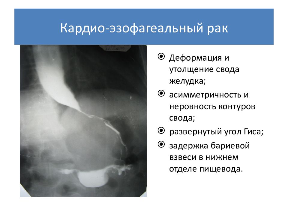 Рак пищевода и желудка онкология презентация