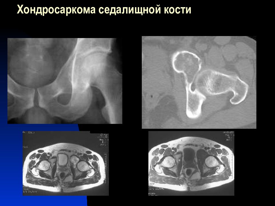 Хондросаркома. Хондросаркома таза рентген. Хондросаркома лонной кости.