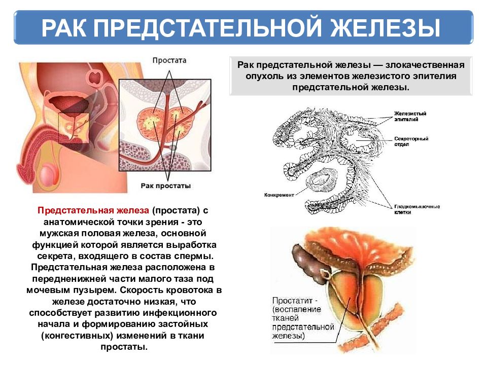 Предстательная железа это простата. ОПК предстательной железы. Злокачественное новообразование предстательной железы. Аденома простаты схема. Простата и предстательная железа.