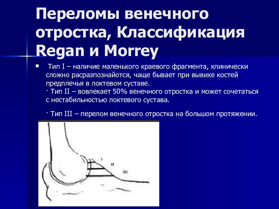 Перелом локтевого отростка. Классификация переломов венечного отростка Regan и Morrey. Перелом локтевого отростка локтевой кости классификация. Перелом венечного отростка локтевой. Краевой перелом венечного отростка.