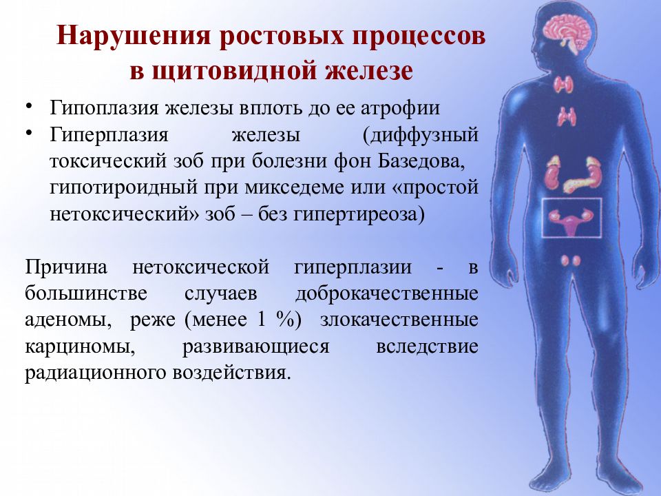 Щитовидная железа гиперплазия. Гипоплазия щитовидной железы. Гипоплазия щитовидной железы железы. Гипоплазия левой доли щитовидной железы.