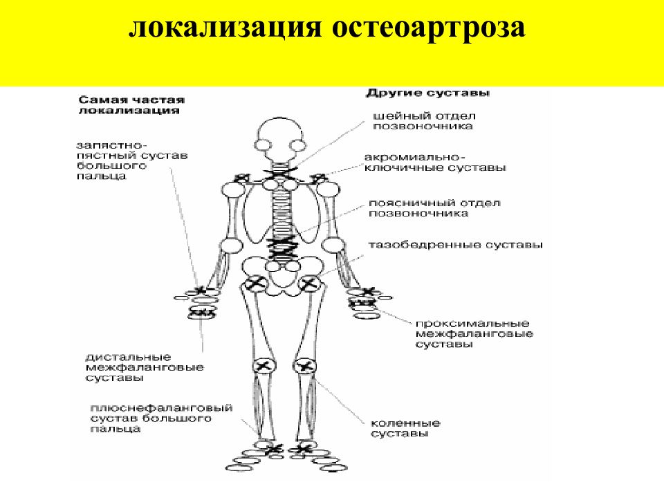 Суставной синдром презентация