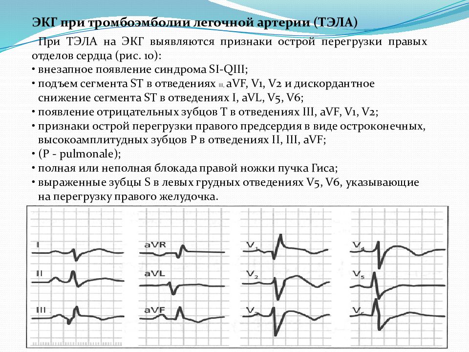 Тэла на экг картинки