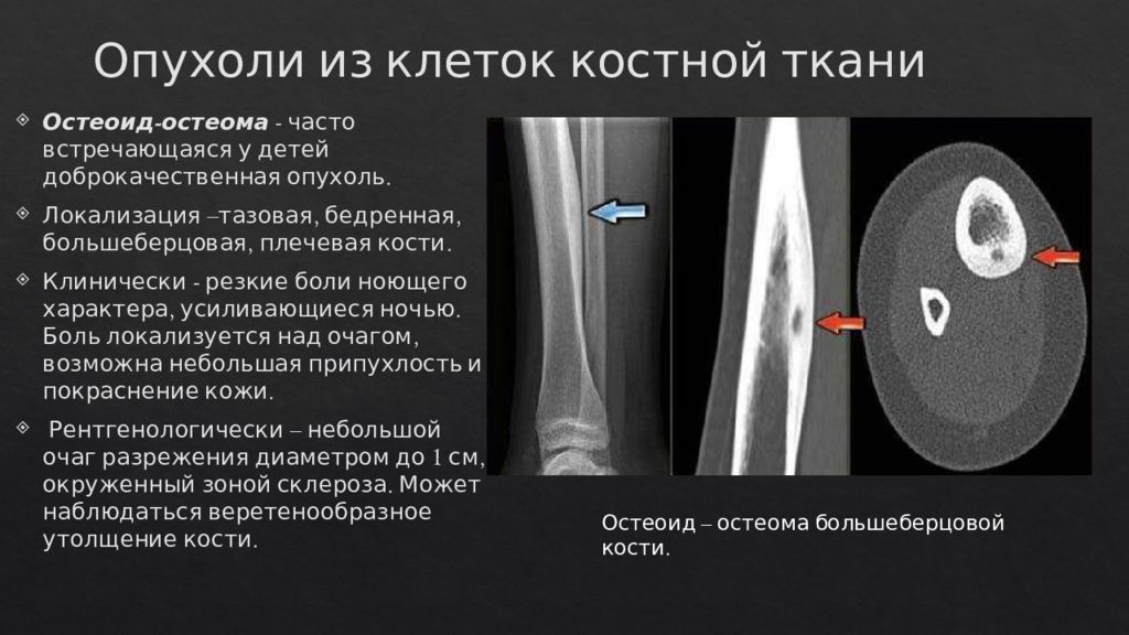 Костный отек. Опухоли большеберцовой кости остеома. Доброкачественные новообразования костей остеоид остеома. Остеоид плечевой кости.