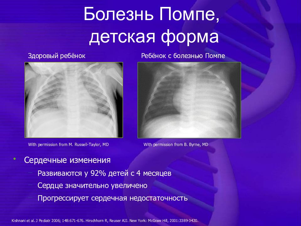 Болезнь помпе картинки