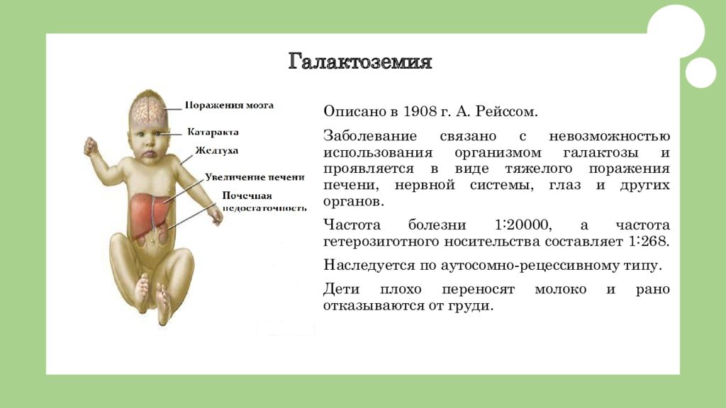 Клиническую картину галактоземии принято объяснять токсическим действием