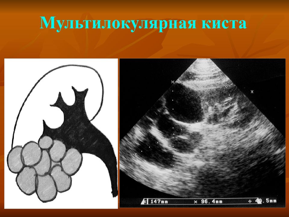 Киста почки. Мультилокулярная киста почки на УЗИ. Мультилокулярная киста. Мультилокулярная кистозная нефрома. Мультилокулярные кисты почек.