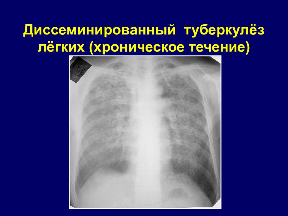 Острый диссеминированный туберкулез. Острый диссеминированный туберкулез рентген. Хронический диссеминированный туберкулез рентген. Лимфогенный диссеминированный туберкулез.