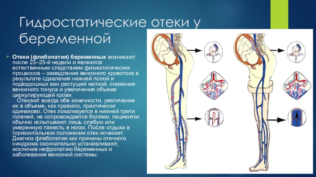 Сильно отекаю при беременности. Гидростатический отек. Отеки вызванные беременностью. Отеки беременных диагноз.