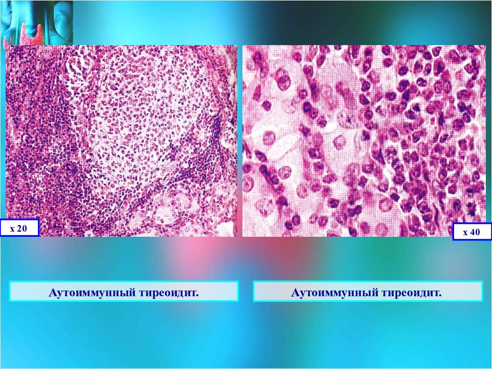 Послеродовый тиреоидит. Тиреоидит Хашимото гистология. Аутоиммунный тиреоидит Хашимото микропрепарат патанатомия. Зоб Хашимото гистология. Аутоиммунный тиреоидит зоб Хашимото микропрепарат.