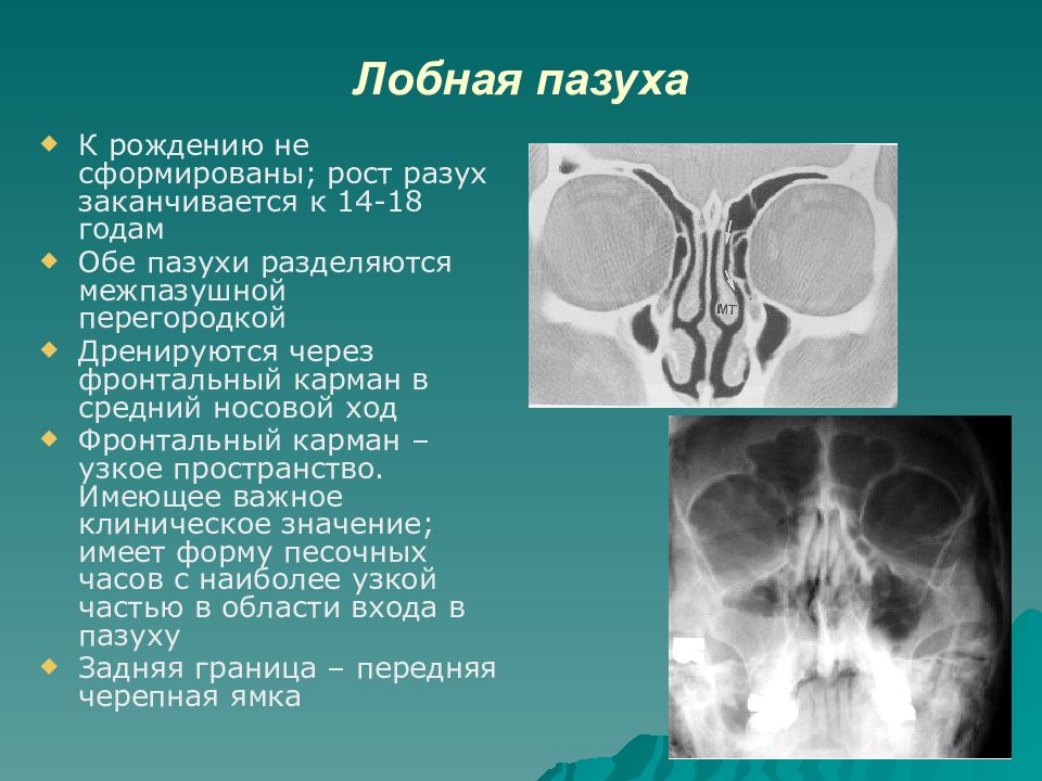 Злокачественная опухоль пазухи носа