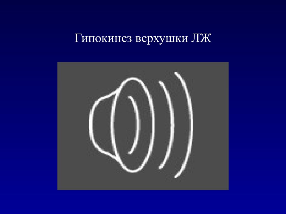 Акинез. Гипокинез. Гипокинез сердца. Гипокинез Нижне боковой стенки. Субкостальная позиция