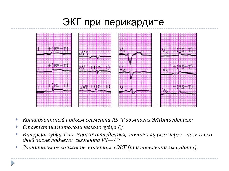 Перикардит экг картина