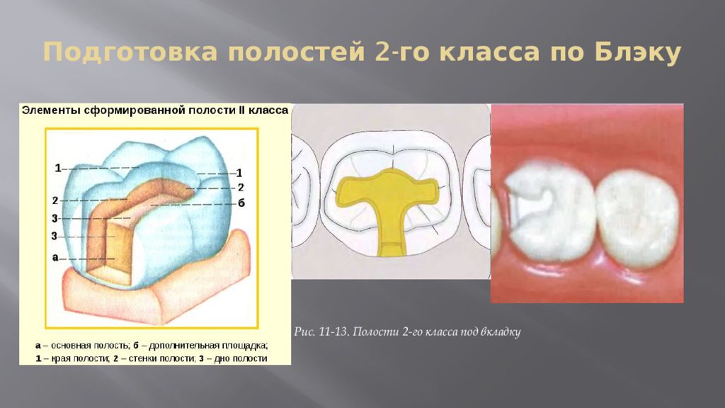 Полость три. Форма полости третьего класса по Блэку. Формирование полости при 2 классе Блэка. Кариес 2 класса по Блэку. Классы по Блэку.