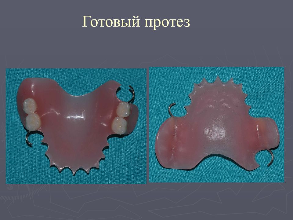 Новые технологии протезов. Съёмный протез по технологии Vertex. Пористость сжатия в готовом протезе.