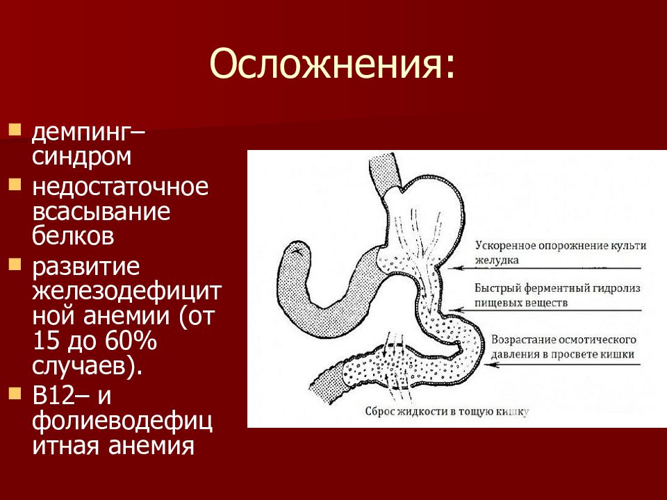Демпинг синдром картинки