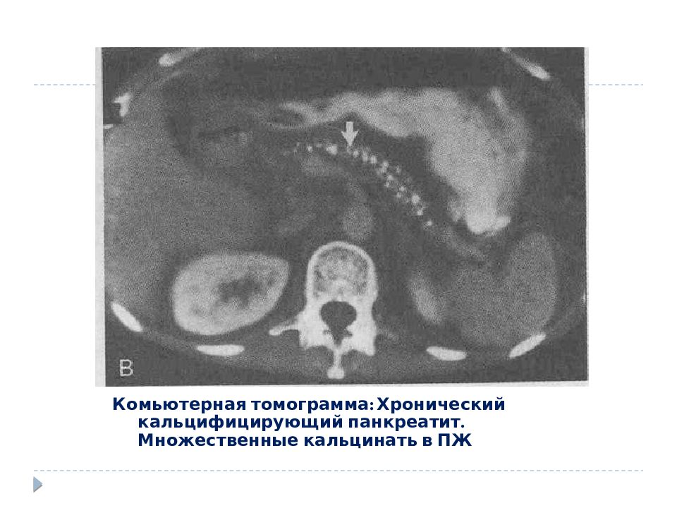 Статистика хронического панкреатита. Панкреатит обызвествляющий. Сестринский уход при хроническом панкреатите презентация. Хронический панкреатит фото. Кальцифицирующий панкреатит.