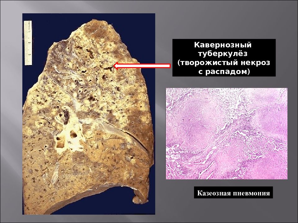 Казеозная пневмония презентация