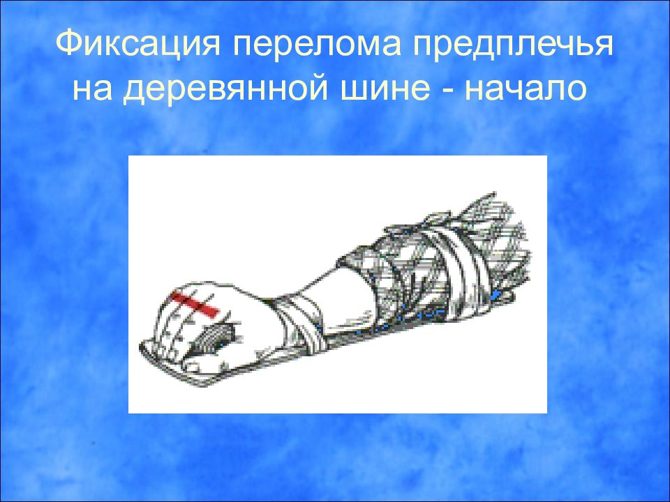 1 помощь при открытом переломе предплечья. Фиксация перелома предплечья. Перелом предплечья шина. ПМП при переломе предплечья. Шина при травме предплечья.