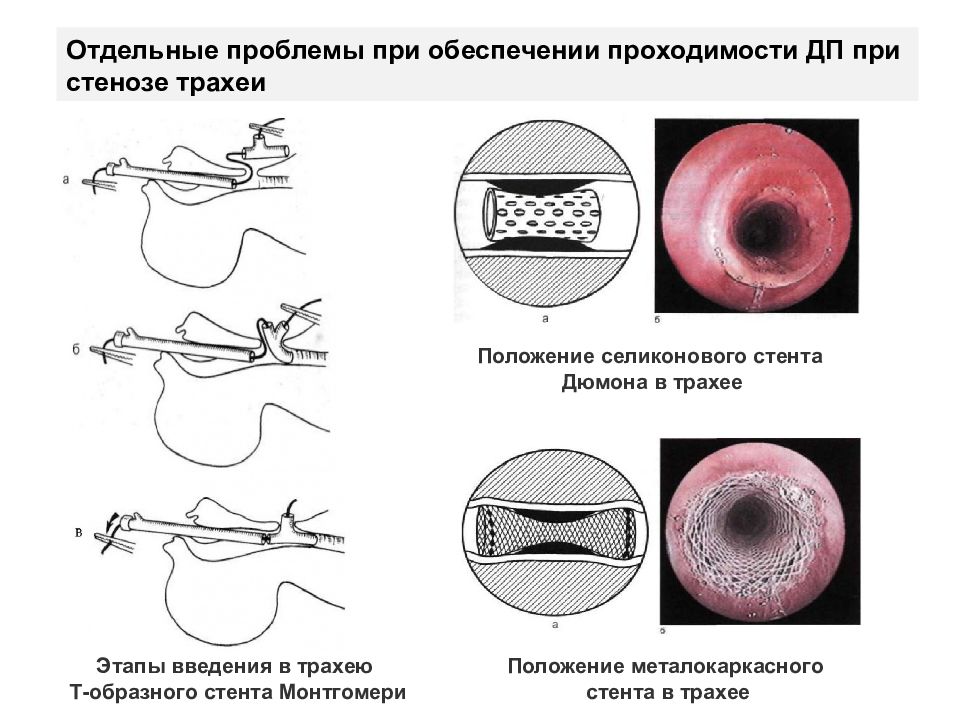 Отдельные проблемы. Т-образный стент трахеи. Бужирование стеноза трахеи. Стеноз трахеи классификация.