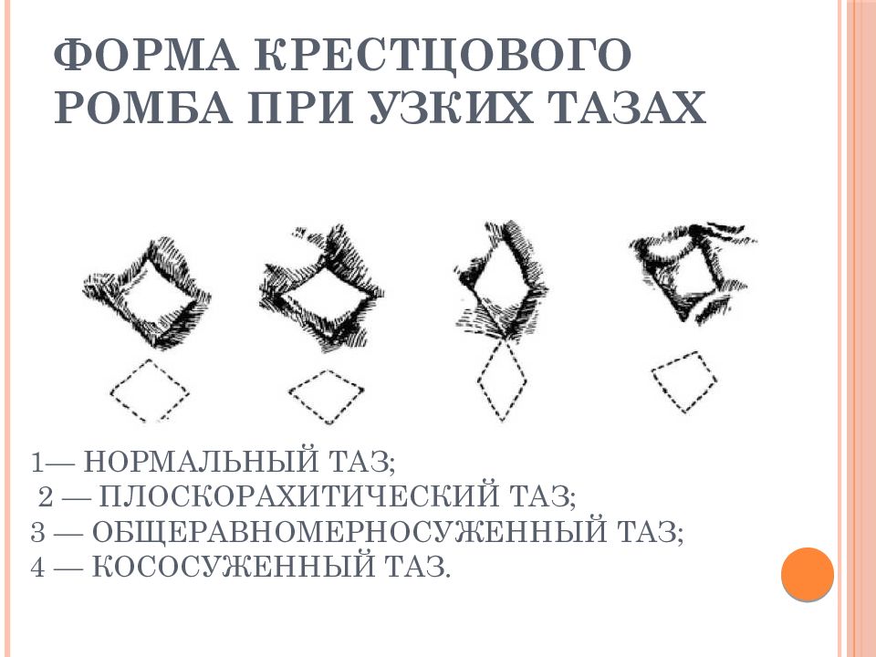 Узко определенный. Формы крестцового ромба при анатомически узком тазе. Формы ромба Михаэлиса. Формы узкого таза в акушерстве.