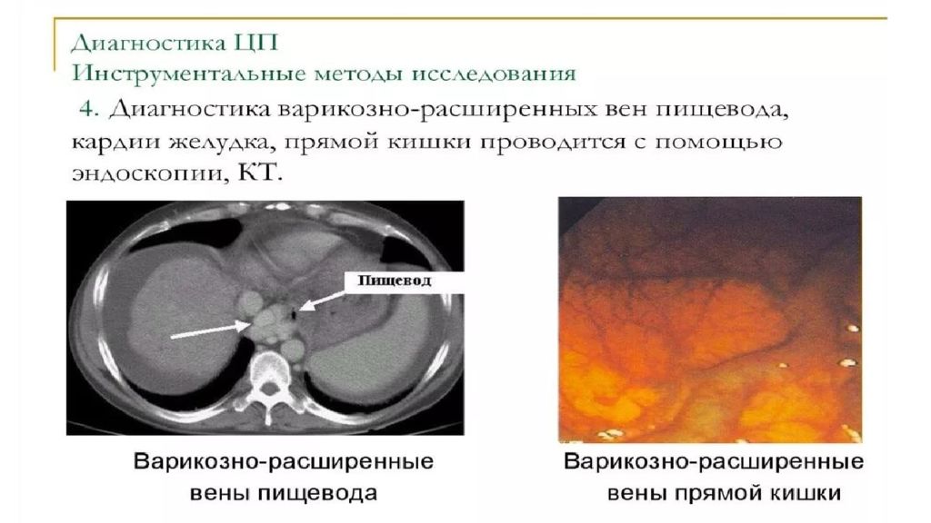 Заболевания диафрагмы презентация