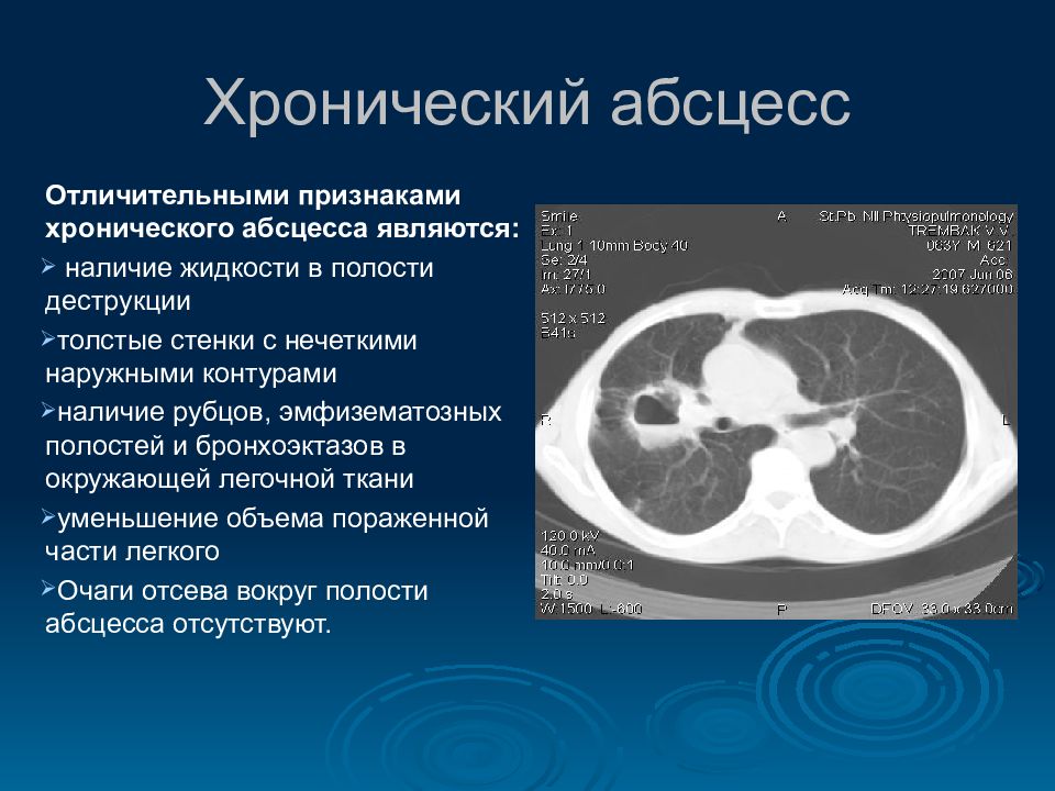 Абсцесс легкого кт картина