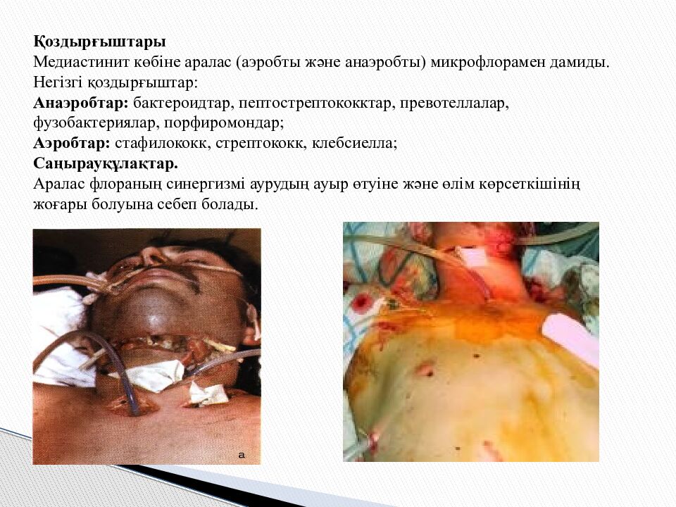 Тақырыбы: Іріңді медиастинит