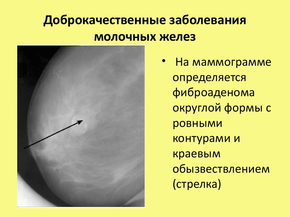 Доброкачественная молочных желез. Доброкачественные новообразования молочной железы. Болезни молочной железы. Методы обследования молочной железы. Методика обследования молочных желез.