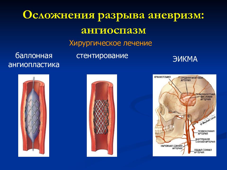 Ангиоспазм. Осложнения ангиопластики.