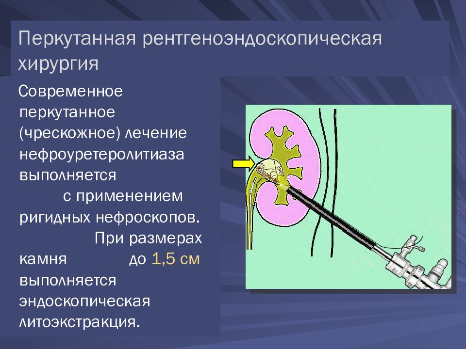 Хирургическое лечение мочекаменной болезни презентация