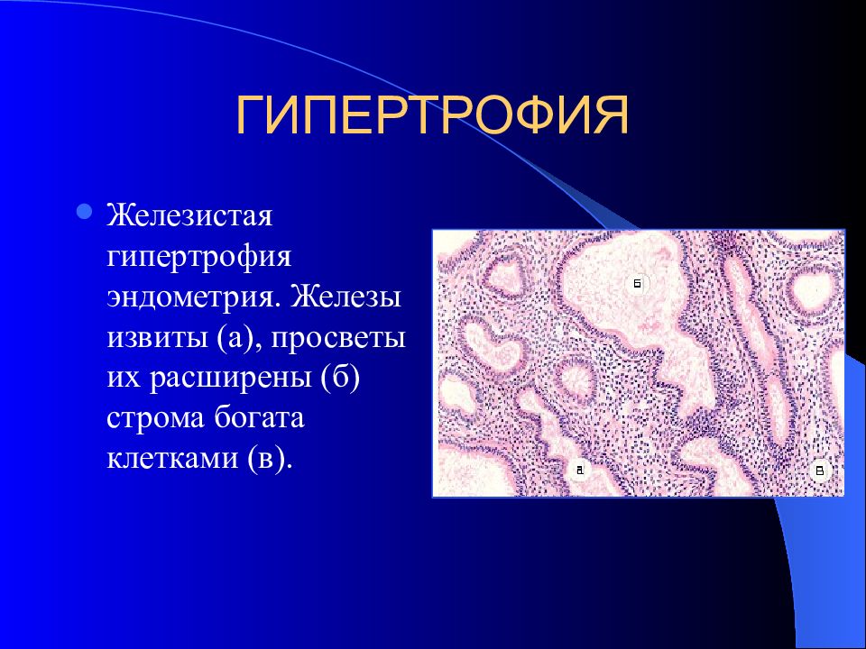 Метаплазия эндометрия. Железистая гипертрофия эндометрия. Регенерация гиперплазия. Гипертрофия и гиперплазия клеток. Организация метаплазия гипертрофия регенерация.