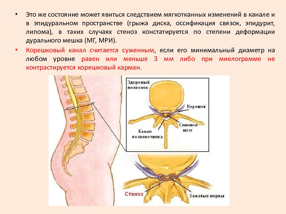 стеноз позвоночного канала l2-l3. врожденная узость позвоночного канала. стеноз грыжи. сужение позвоночного канала. рентген пояснично-крестцового отдела грыжа.